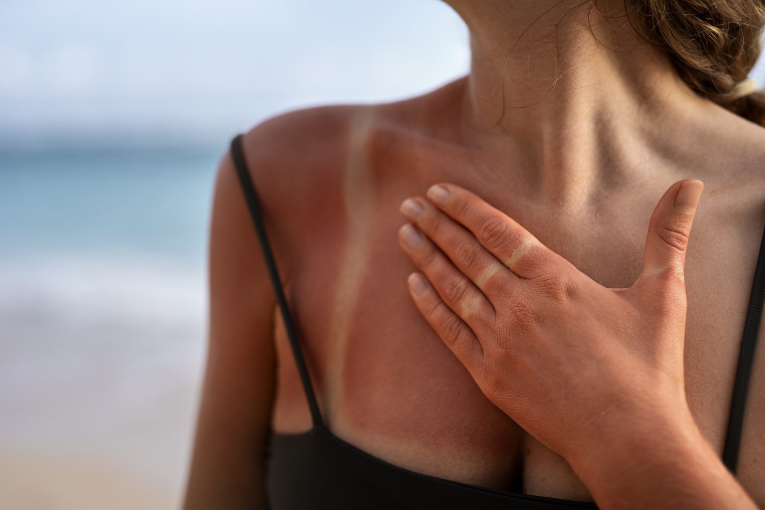 details-woman-s-sunburn-skin-from-beach-sun (1)