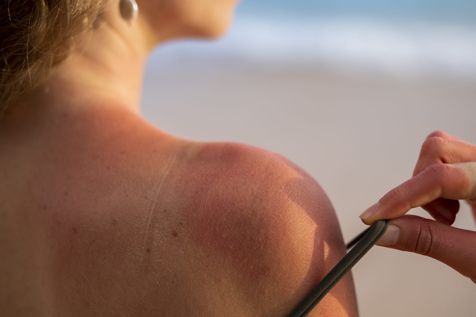 details-woman-s-sunburn-skin-from-beach-sun